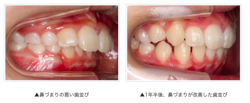 歯並び写真