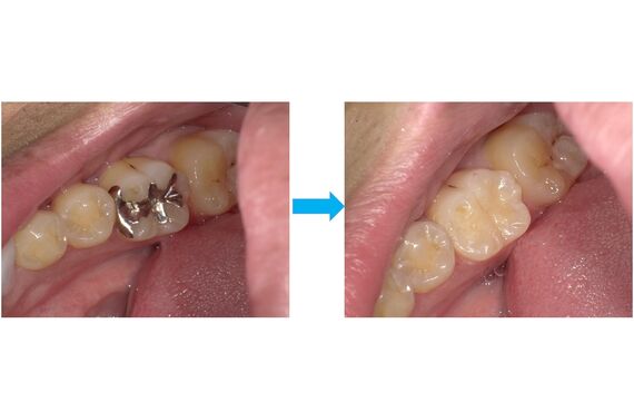銀の詰め物を白くする。安く白い詰め物にかえるメリット、デメリット
