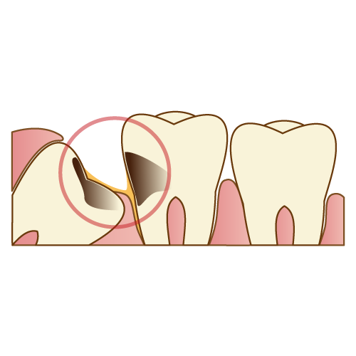 親知らずの虫歯の写真