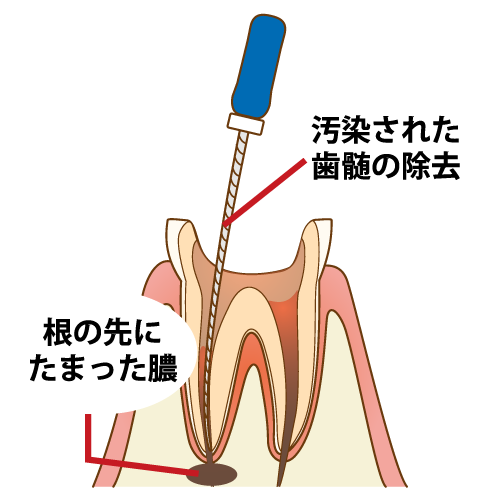 根管治療中の写真