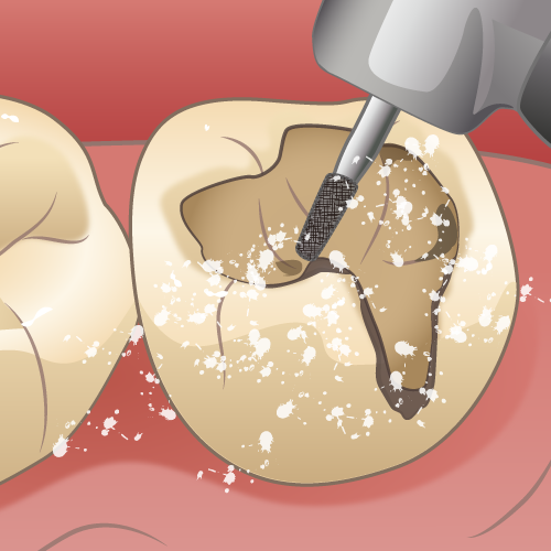 歯を削っている写真