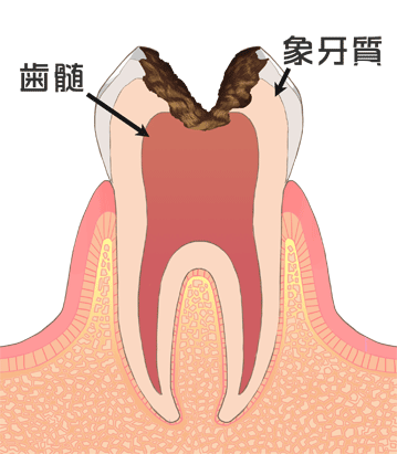 歯髄の写真