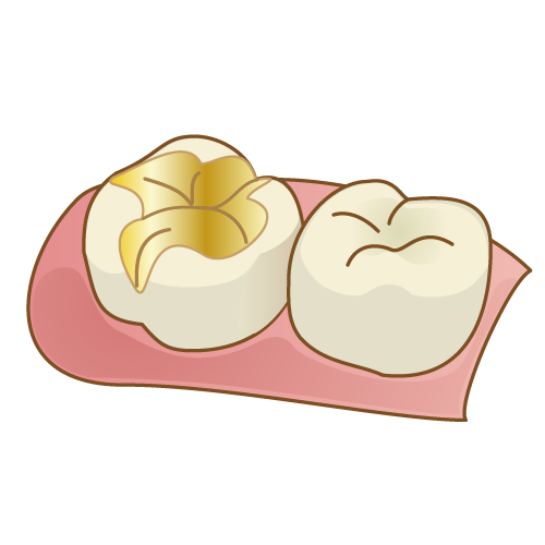 金の詰め物