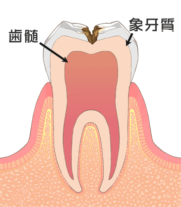 虫歯の断面の写真