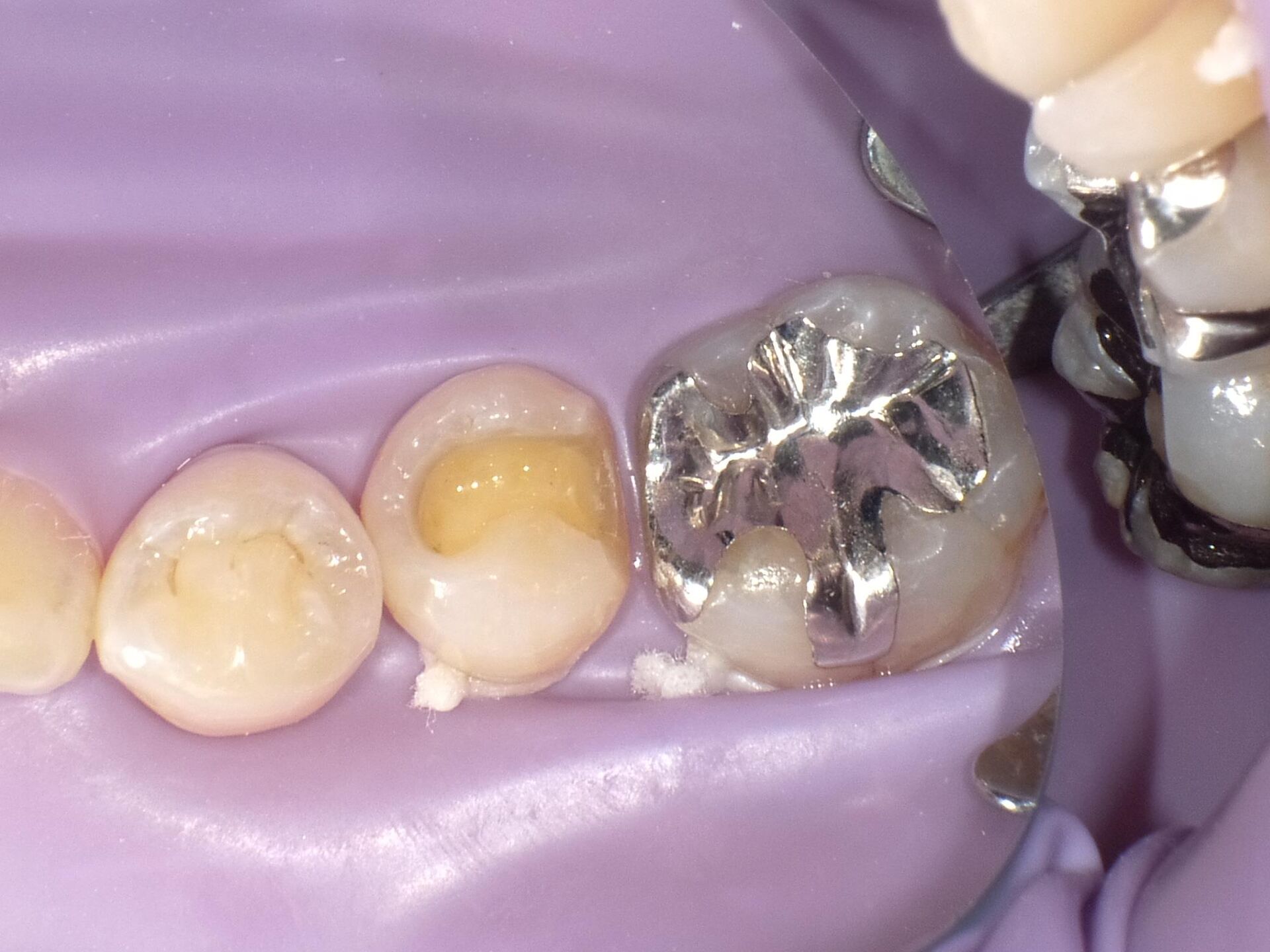 ラバーダムの写真